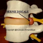 hernie-discale